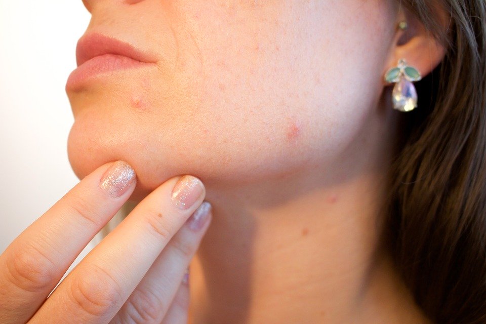 Skin Acne Skincare Pimple Pores Face Female